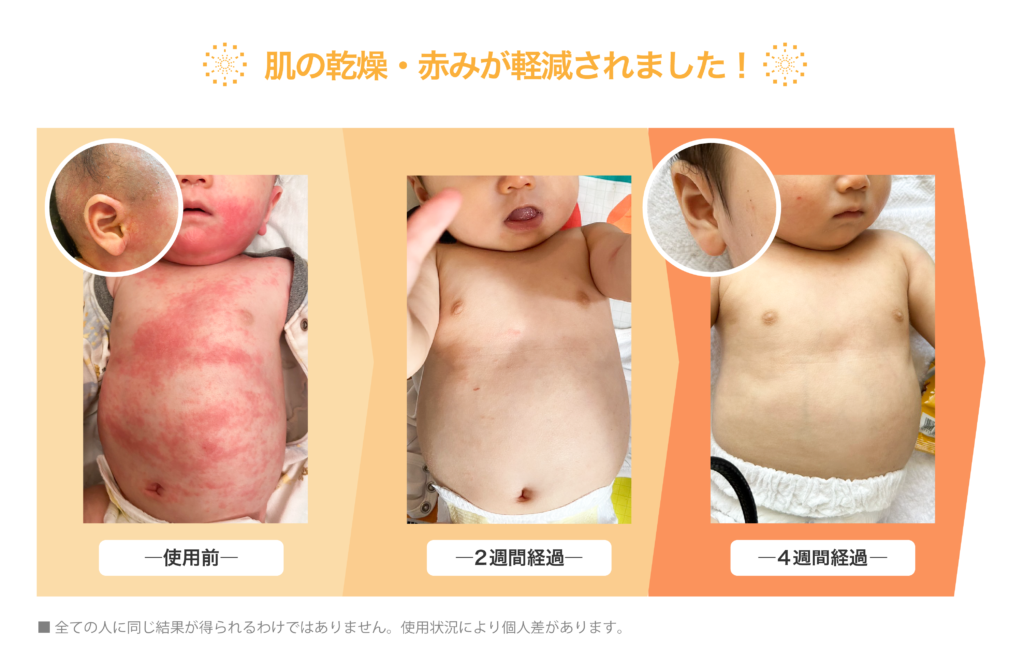 ミラブルZEROを用いて、赤ちゃんの肌が改善されていく様子。 ※効果には個人差があります。